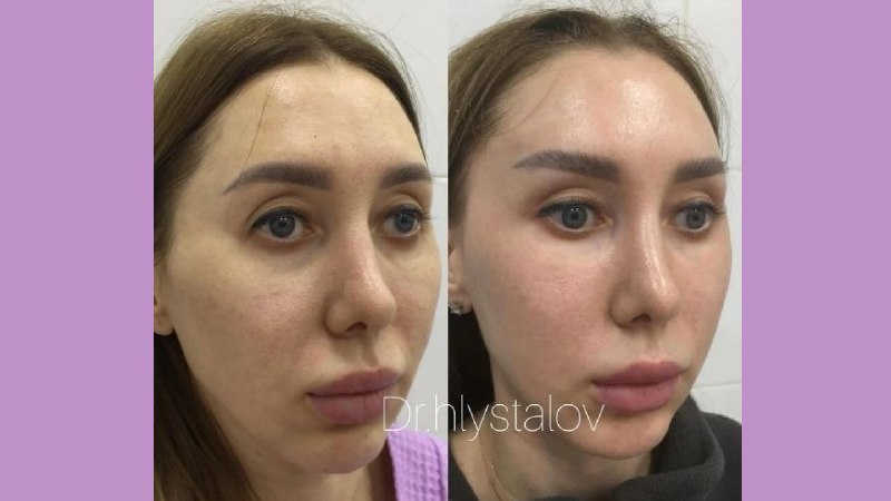 Пластический Хирург | Хлысталов Максим